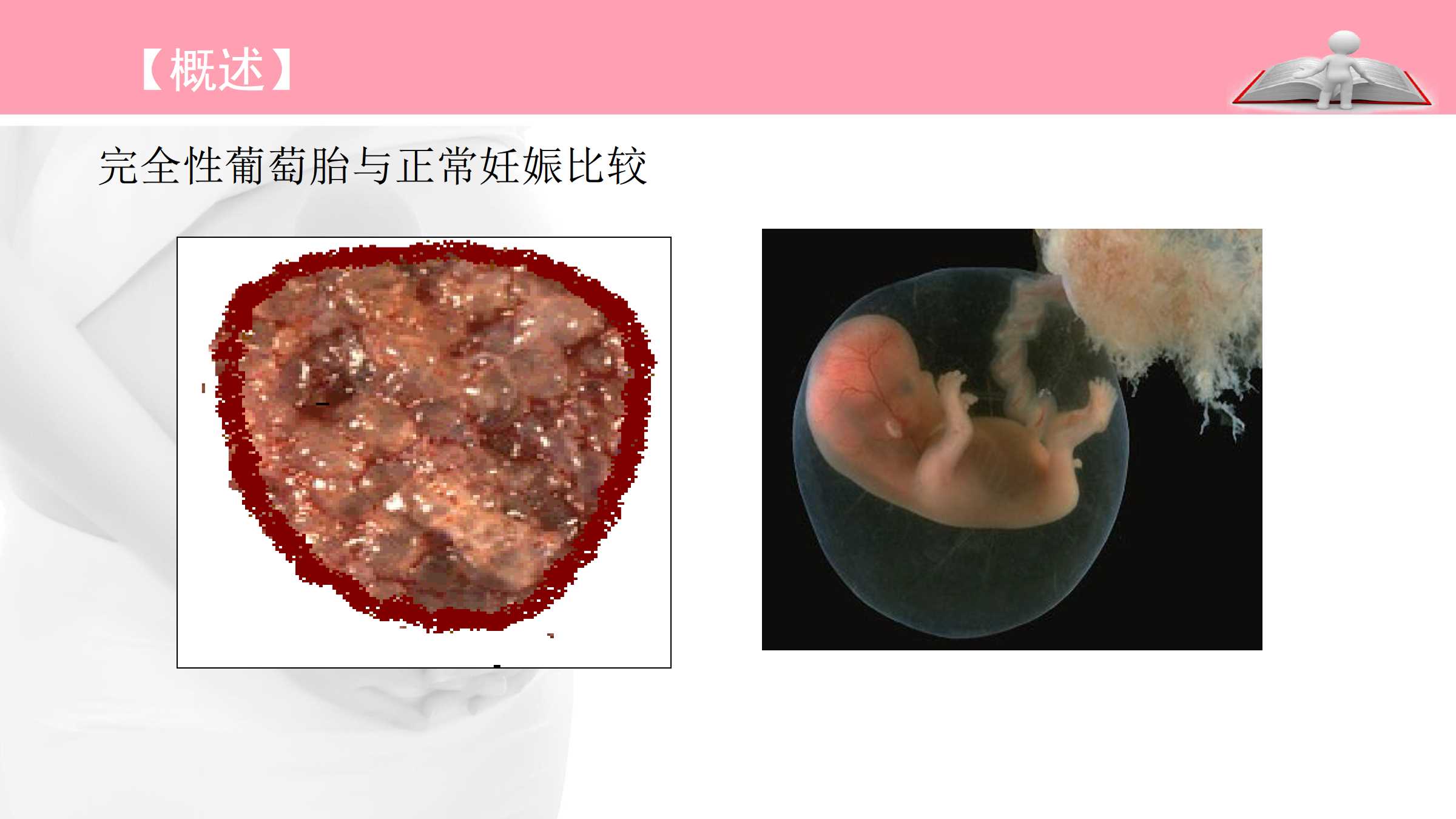 4.1 葡萄胎