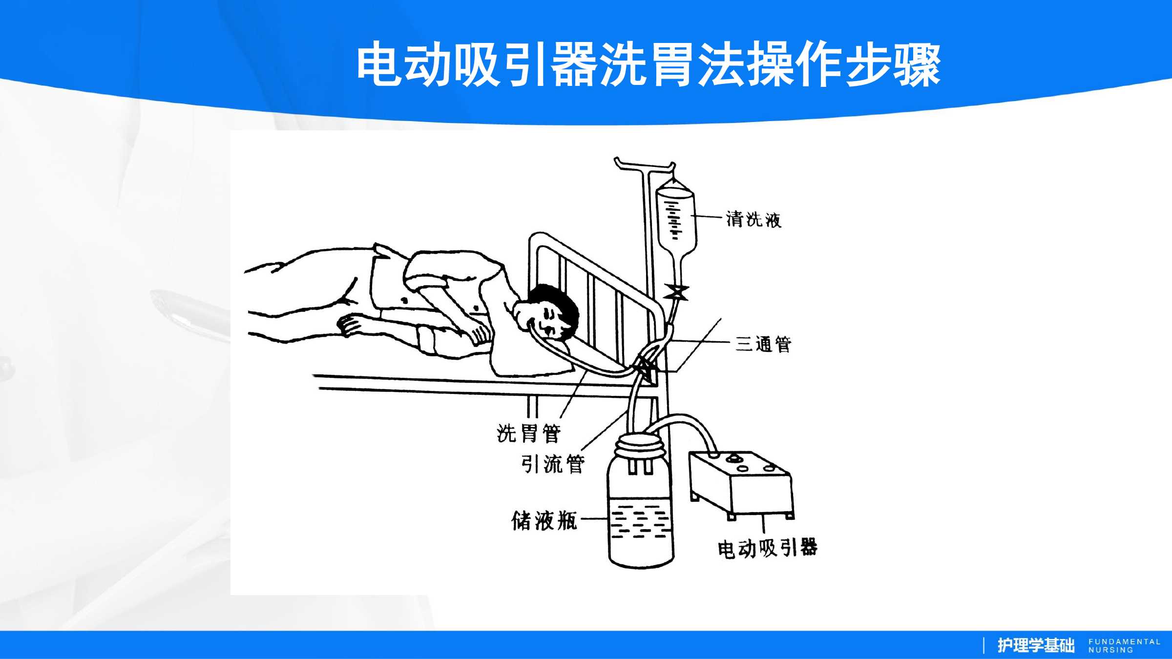 1.5洗胃法 所属课程《护理学基础实训指导及习题集》